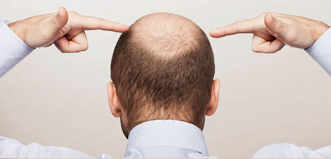 Существует ли эффективное средство от выпадения волос у мужчин ...
