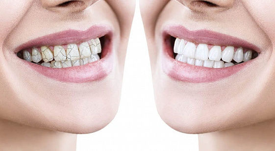 Зубы могут начать крошиться: какие продукты разрушают зубную эмаль